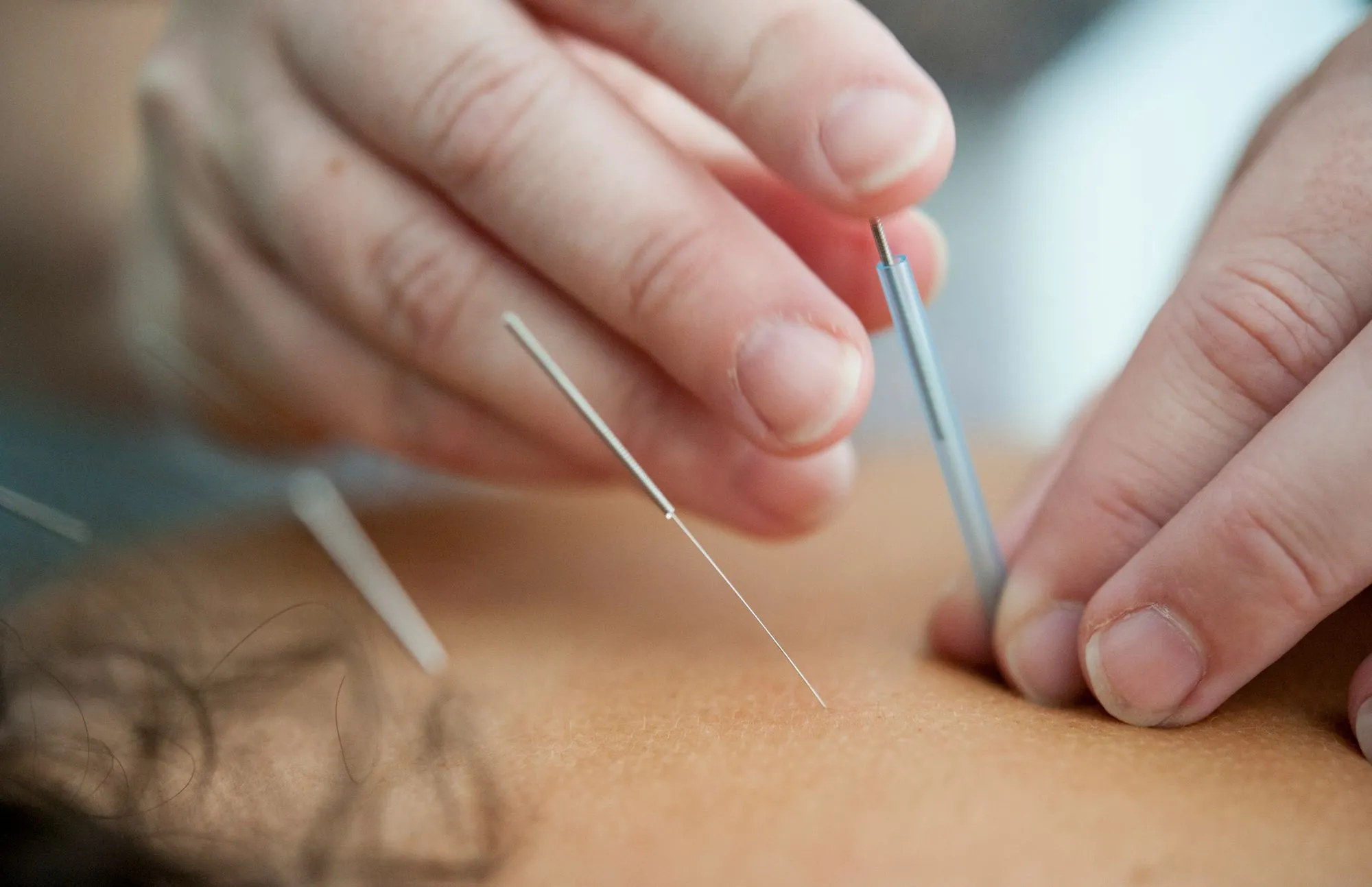Acupuncture For Pregnancy